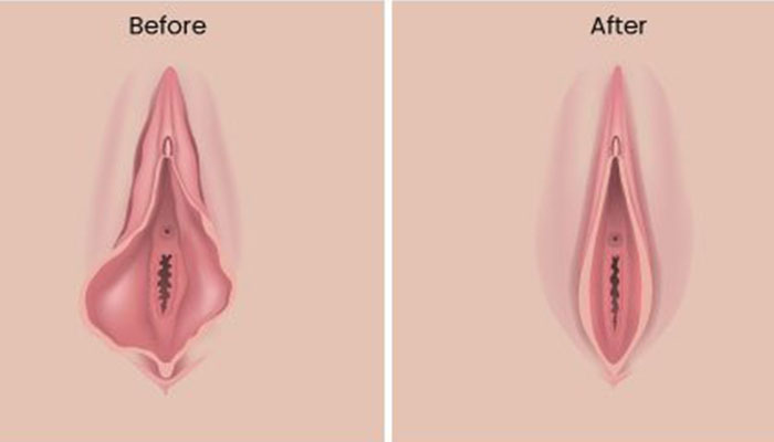 جراحی زیبایی واژن لابیاپلاستی