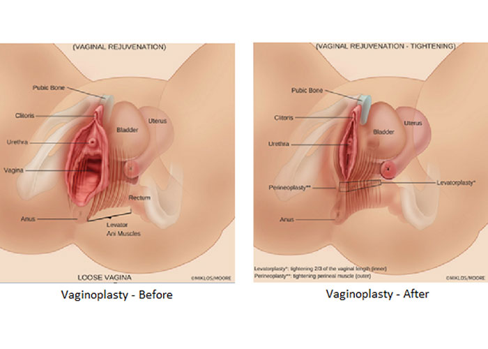 جراحی زیبایی واژن واژینوپلاستی