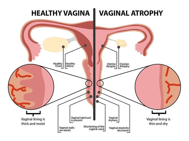 آتروفی واژن چیست