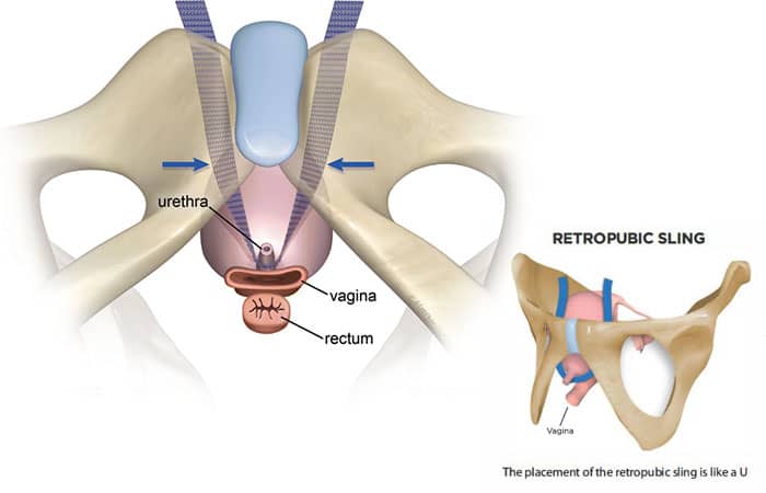 جراحی اسلینگ مجرای ادرار به روش رتروپوبیک