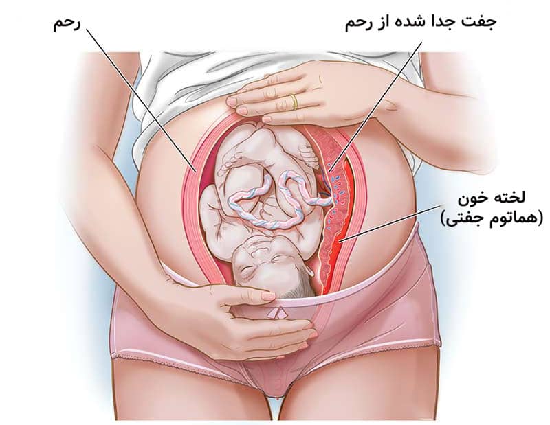 هماتوم در بارداری (هماتوم جفتی) چیست