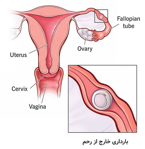 عوارض بارداری بعد از بستن لوله های رحم