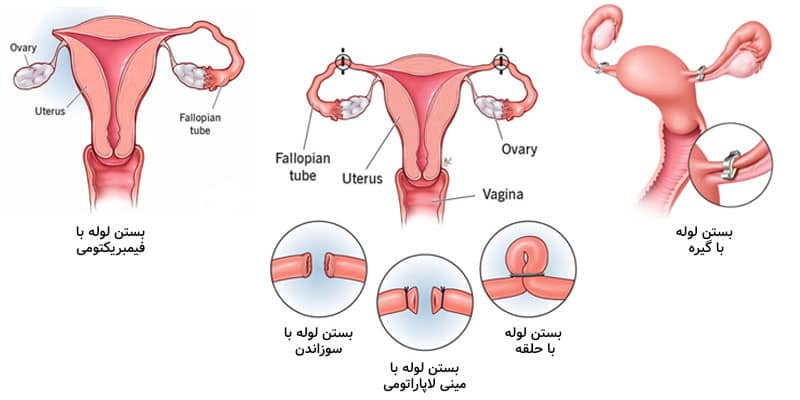 انواع روشهای جراحی عقیم سازی زنان