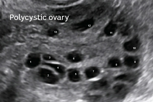 سونوگرافی برای تشخیص تنبلی تخمدان