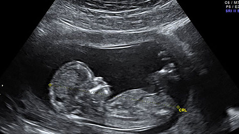 سونوگرافی در بارداری کودک 22 هفته