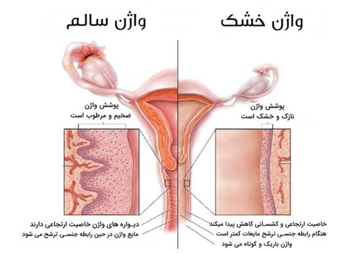 تشخیص خشکی و سوزش واژن