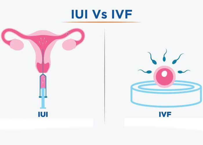 تفاوت درمان ناباروری با IUI و IVF