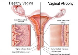 آتروفی واژن چیست و چه درمانی دارد