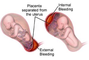 هماتوم ساب کوریونیک یا هماتوم در بارداری