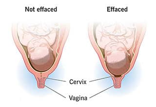 تنک کردن و درمان گشادی واژن بعد از زایمان طبیعی