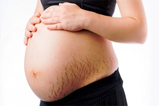 درمان ترک های پوستی بارداری