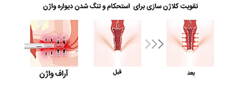 فیلم درمان واژینیسموس با آر اف + هزینه درمان واژینیسموس با آر اف